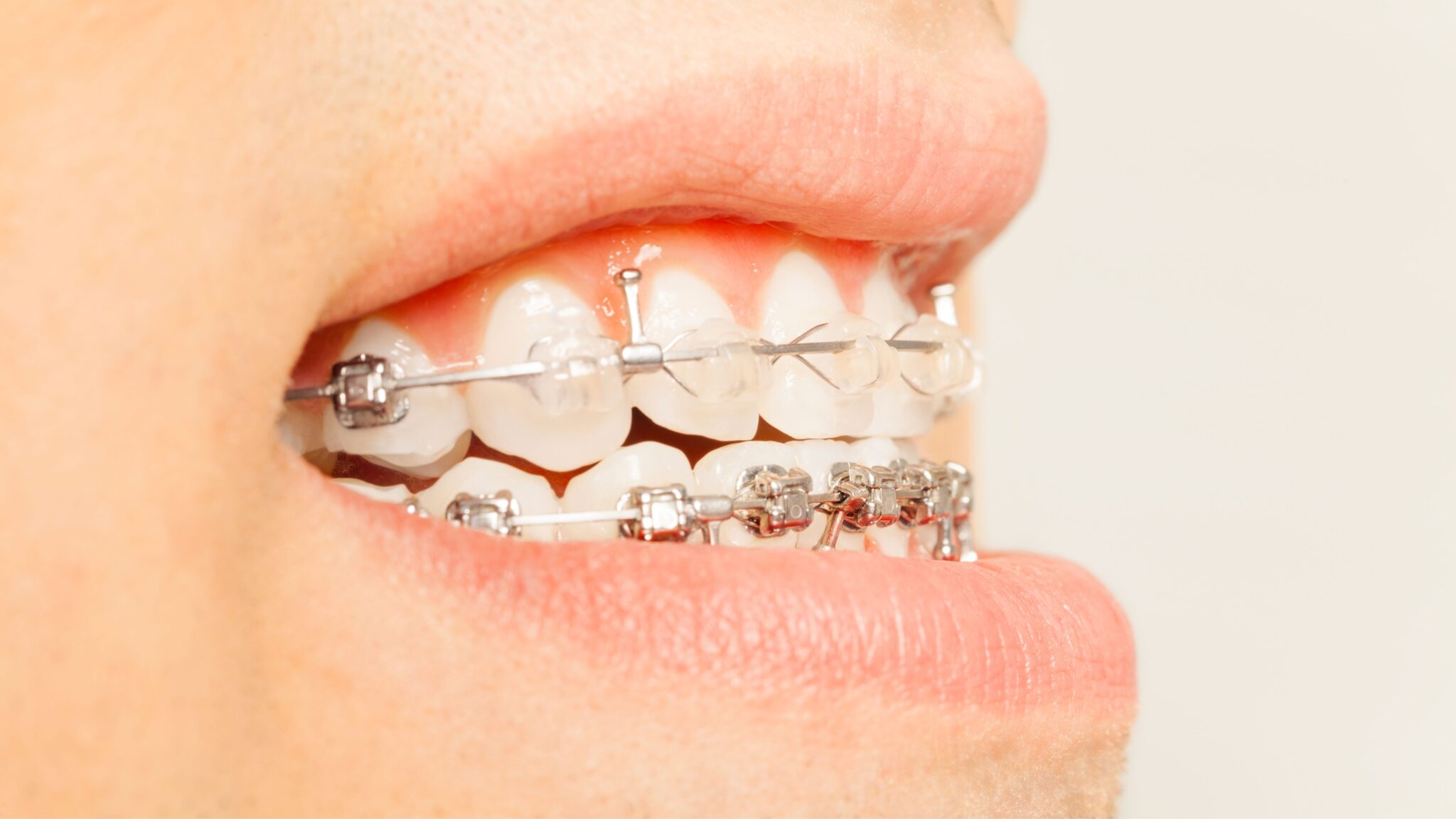 Tipos De Ortodoncia | Asistencia Dental Especializada